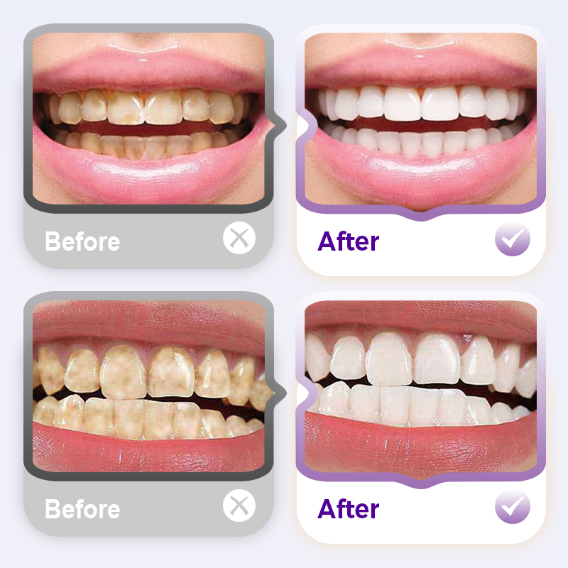 Lysozyme Brightening Stain-Removing Toothpaste