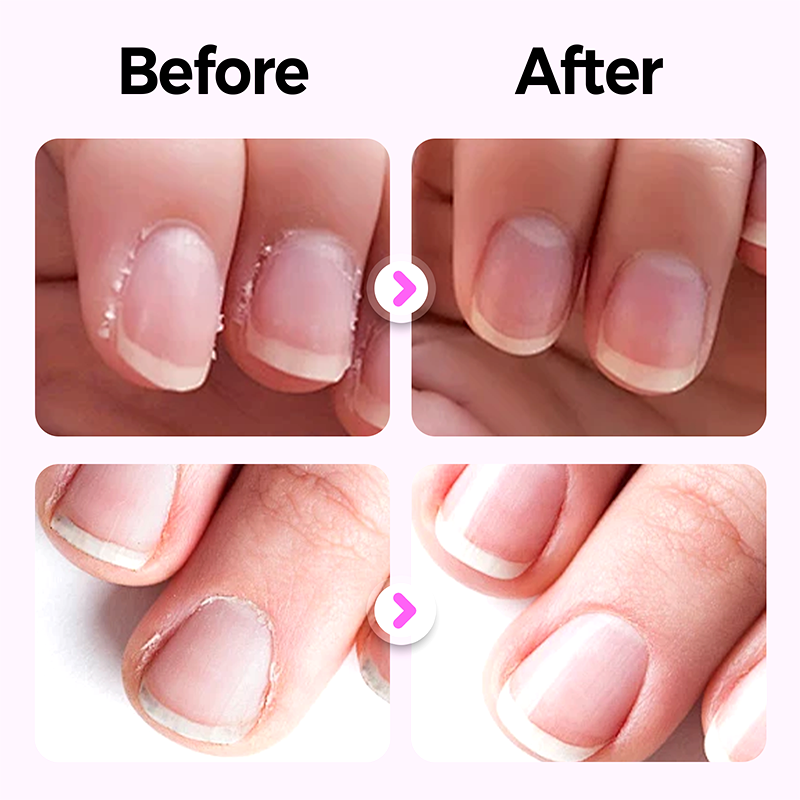 🌟Hot Sale 50% OFF🌟2025 New Upgraded 3-in-1 Nail Care Pen💅